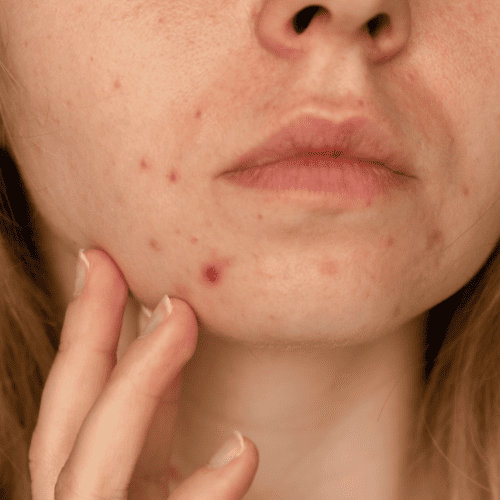 Texture and scarring