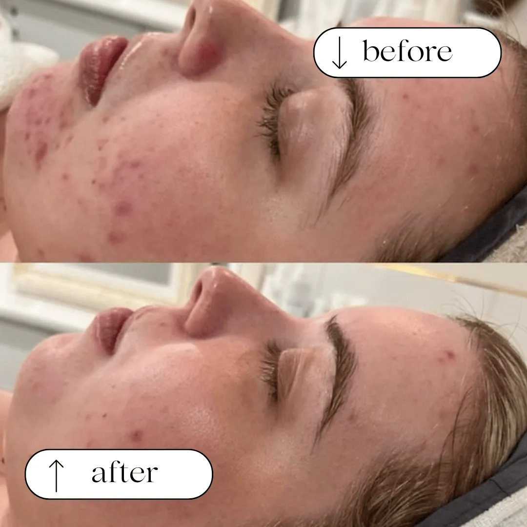 Acne and breakout transformation before and after