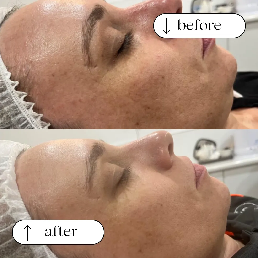 Texture and redness transformation before and after
